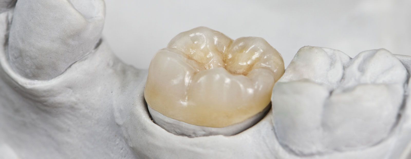 Porcelain Crowns & Bridges Dayton, OH