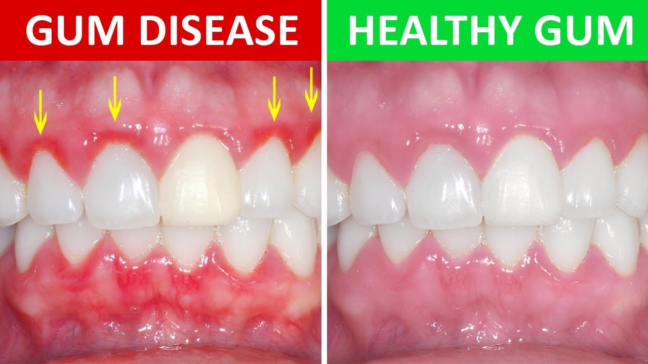 gum disease vs healthy gums