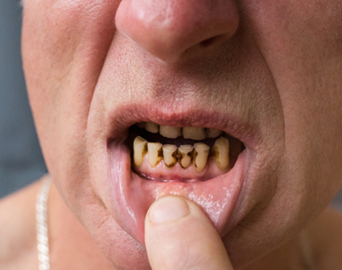 Meth Mouth: How Methamphetamine Use Affects Dental Health